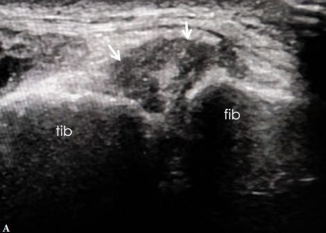 Sindesmosis tibioperonea tempo formacion ecografia 5.jpg